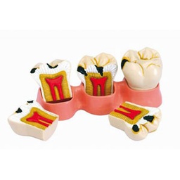 [z9608] Modelo estados de la caries